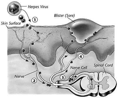 怀孕了发现外阴长疱疹,怀孕4个月疱疹复发