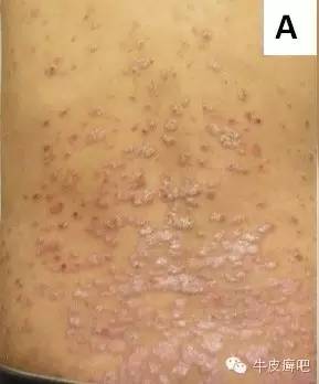 皮肤科专家谈论银屑病生物制剂,中国治疗银屑病新药生物制剂