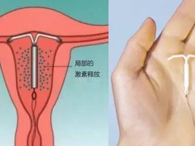 女性上环对血压有影响吗,女性上环前需要注意什么