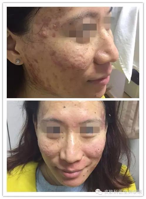 透明质酸护肤品功效,透明质酸是修复皮肤敏感成分