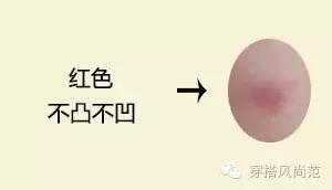 真实祛痘印最有效的方法,祛痘印最好的方法目前最有效的