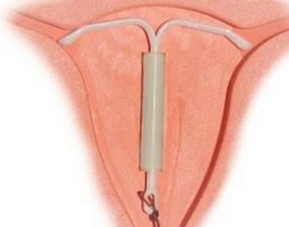 你被强迫上环了吗？请善待你老婆的身体，看了想骂人！