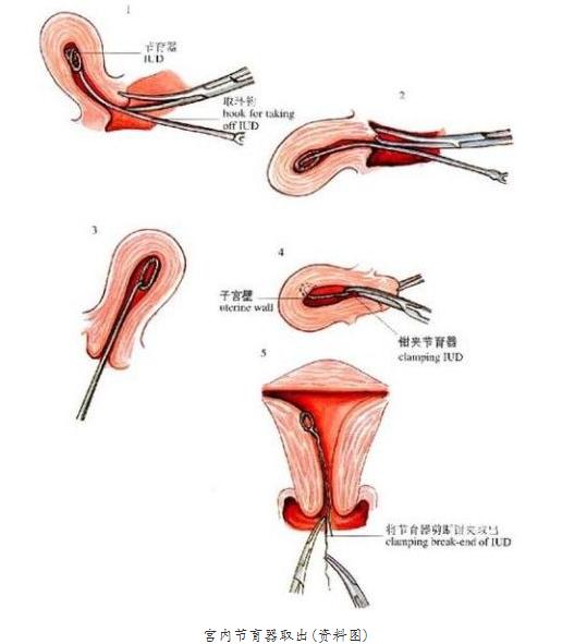 现代女性戴环过程痛苦吗,妇女戴环是啥样的