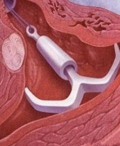 现代女性戴环过程痛苦吗,妇女戴环是啥样的