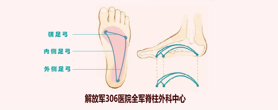 扁平足需要垫足弓吗,扁平足足弓套有用吗