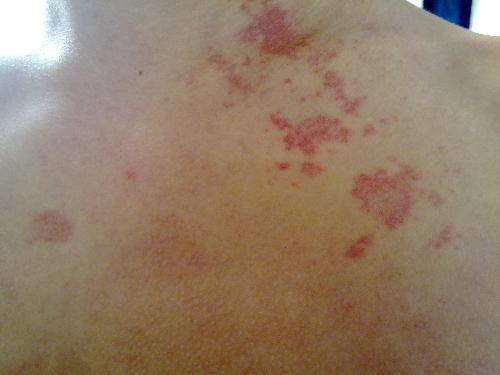 治汗斑有什么土方法,汗斑可以彻底治好吗