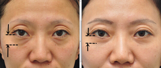 如何区分眼袋泪沟和卧蚕,如何区分眼袋和卧蚕泪沟