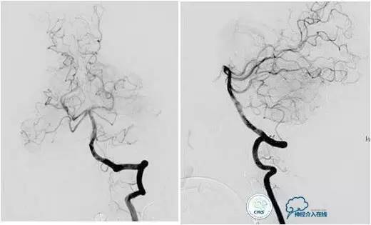 球囊辅助Onyx栓塞治疗硬脑膜动静脉瘘（DAVF）