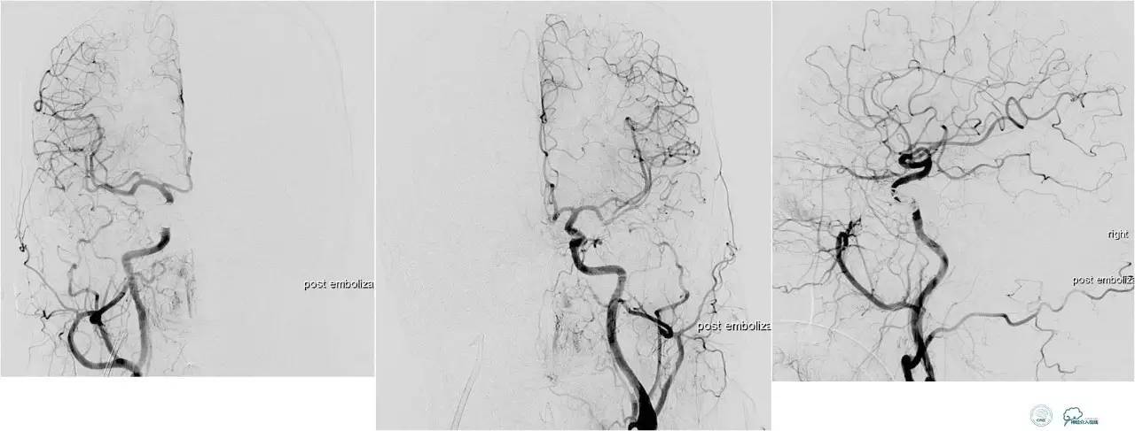球囊辅助Onyx栓塞治疗硬脑膜动静脉瘘（DAVF）