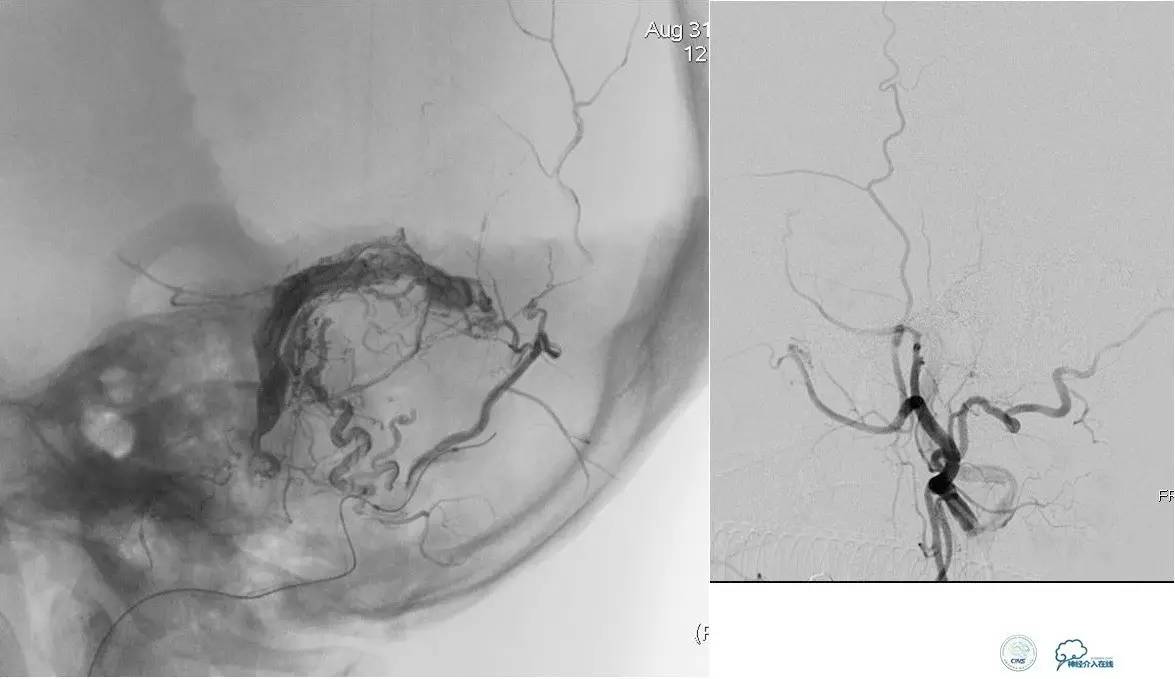 球囊辅助Onyx栓塞治疗硬脑膜动静脉瘘（DAVF）