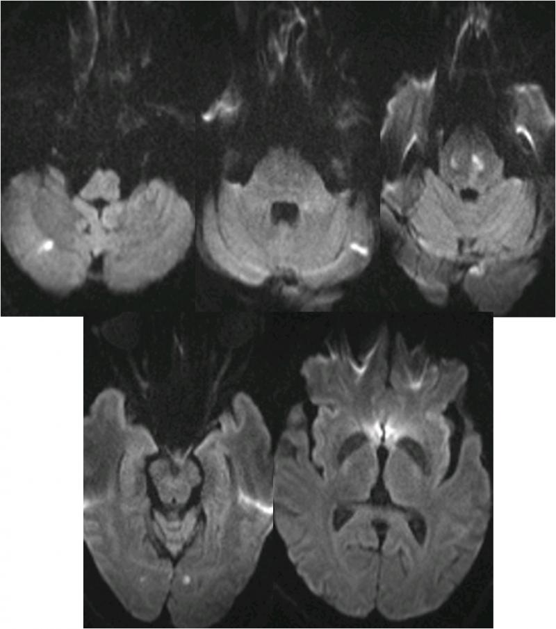缺血性脑卒中术后管理,急性缺血性脑卒中血管内治疗