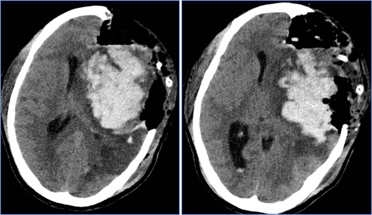缺血性脑卒中术后管理,急性缺血性脑卒中血管内治疗