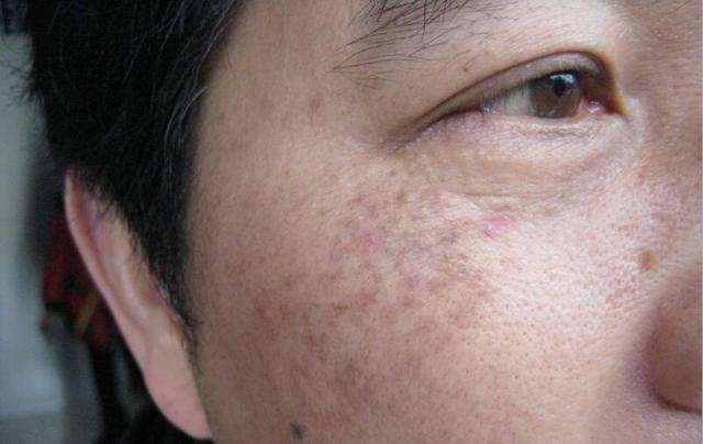 很多人不知道，五毛钱淡斑法，告别“斑女郎”肌肤雪嫩细滑如水