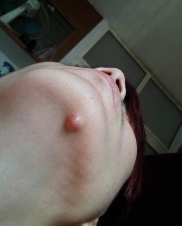 大姨妈前下巴长痘痘怎么调理,下巴长痘痘怎么调理喝什么茶