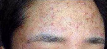 青春期额头上长痘痘是什么原因,30多岁额头长痘痘是什么原因