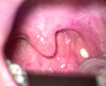 喉咙处有口臭是怎么回事,喉咙有异物感且伴有口臭