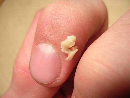 口臭喉咙有痰看哪一科,口臭喉咙经常咳出一坨东西怎样治