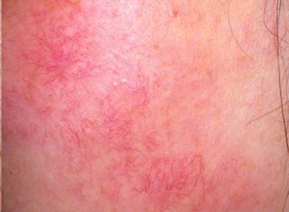 根治红血丝最好的方法,红血丝祛除最有效方法有哪些