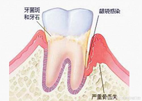 顽固性牙菌斑怎么解决,5分钟内消除牙菌斑的6种有效方法