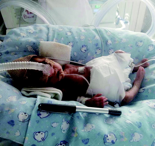 龙凤胎早产在保温箱多少天,龙凤胎住保温箱视频