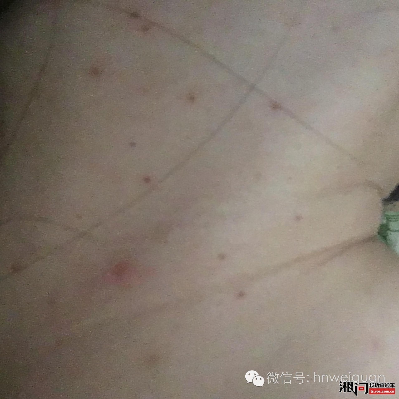 调查花1000元治扁平疣？文峰美容美发被指消费欺诈