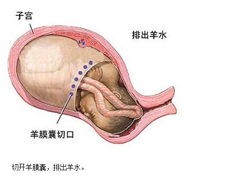 剖腹产没有想象中的那么可怕,剖腹产手术中的真实感受