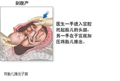 剖腹产没有想象中的那么可怕,剖腹产手术中的真实感受