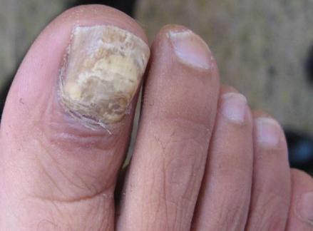 脚趾灰指甲对身体有什么危害,灰指甲烂到根部不治疗有什么危害