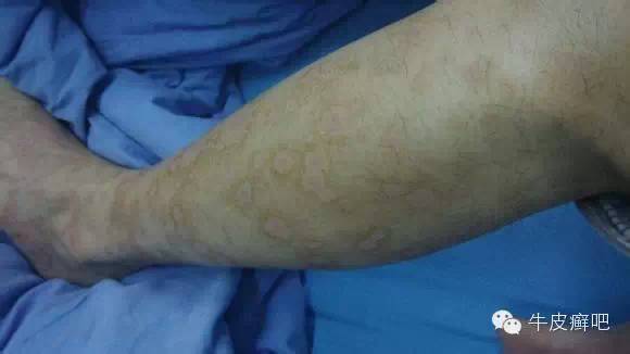 医院专家教你治疗牛皮癣,专家专治牛皮癣方法