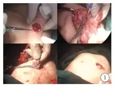 手术演示肠造口术后单切口腹腔镜辅助巨结肠根治术（Duhame1术）