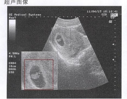 早孕试纸一浅一深是怀孕了吗,早孕试纸一深一浅怎么办