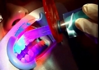 氟斑牙怎么办,氟斑牙怎么办知乎