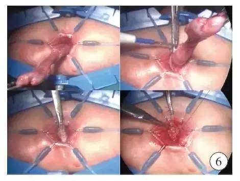 手术演示肠造口术后单切口腹腔镜辅助巨结肠根治术（Duhame1术）