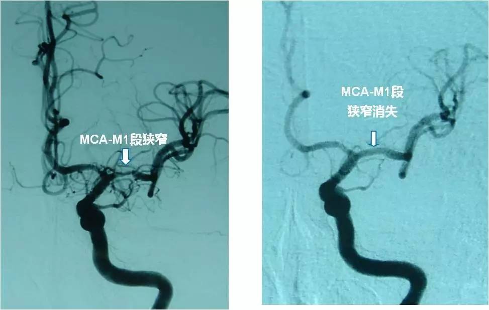 介入医学手术类视频,颈动脉介入手术病例分享