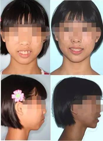 矫牙经历的几个阶段,科普牙齿矫正一定要拔牙吗