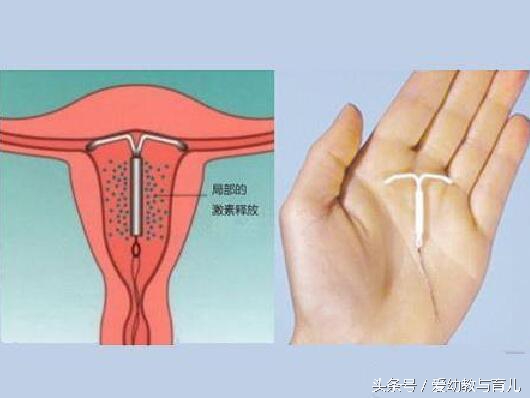 剖腹产取环有困难不,剖腹产的妇女摘环难吗