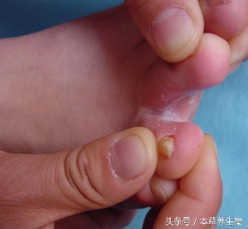 脚上脱皮红疱疹怎么根治,脚上反复起水泡脱皮开裂怎么治疗