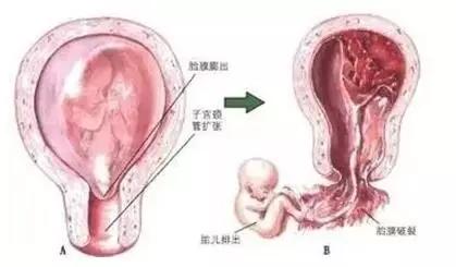 宫颈内口松弛是什么原因引起,宫颈内口松弛流产几率