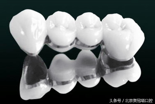 到底应不应该做烤瓷牙,来自医生的忠告不要随便做烤瓷牙