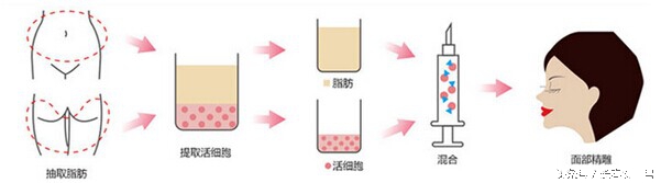 美容填充是怎么填的,脂肪填充和玻尿酸区别在哪