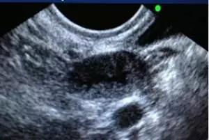 试管婴儿成功后多长时间检查一次,试管婴儿一周做一次超声