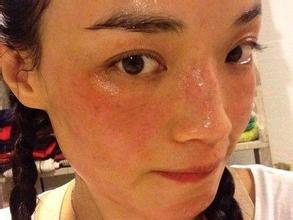 皮肤反复过敏红痒是什么原因,脸部反复过敏什么原因