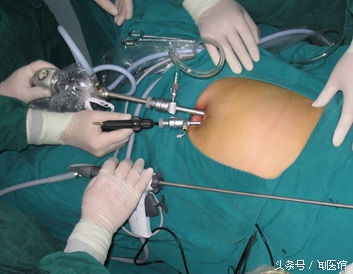 卵巢囊肿11厘米要怎么手术,卵巢囊肿16厘米手术方式