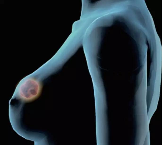 北京大学肿瘤医院徐光炜教授为我国两癌筛查提8条建议