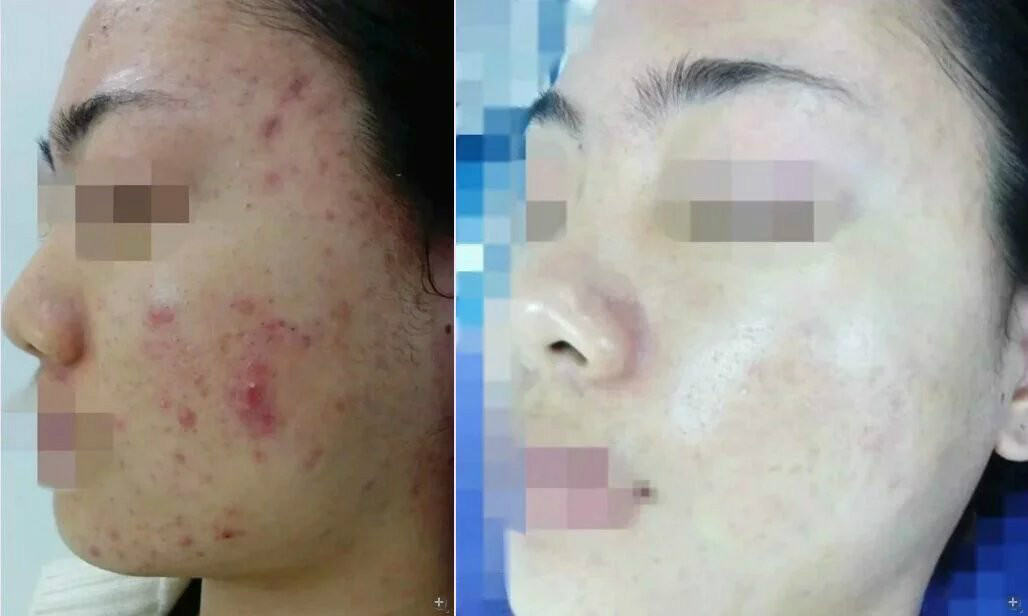 蛋清加什么祛痘印,每天早上轻轻涂抹这东西巧妙祛痘