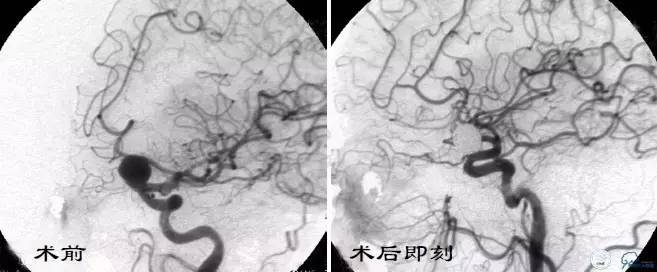 床突旁动脉瘤的血管内治疗