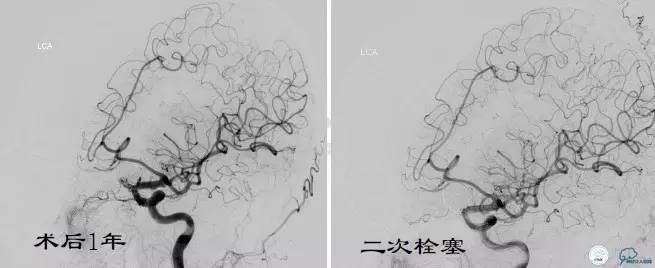 床突旁动脉瘤的血管内治疗