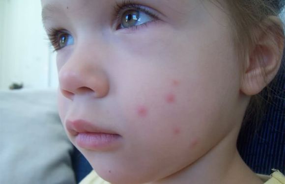 湿疹、痘痘、痱子、蚊虫叮咬、烧烫伤，1款自制中药膏好用