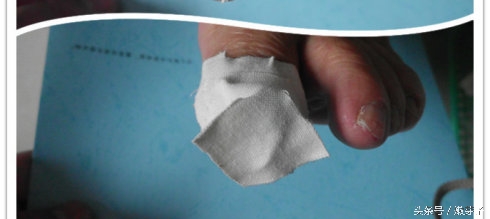 灰指甲包甲步骤及用药