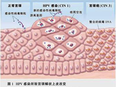 hpv12型阳性可怕吗,hiv和hpv哪个更可怕